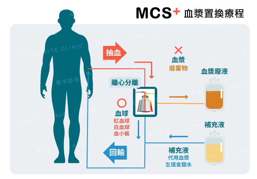 雅丰服務項目, 健康醫學, MCS+血漿置換, 體內淨化, 血漿分離