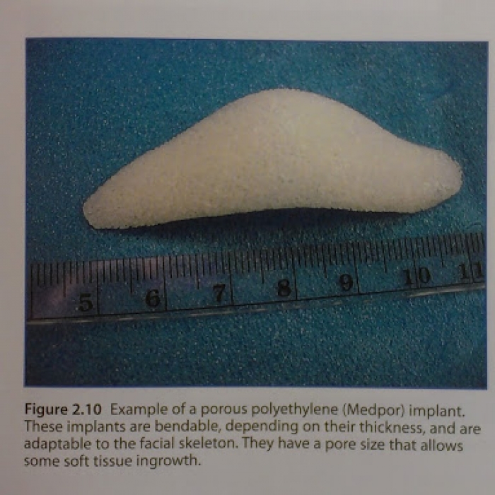 關於medpor人工骨 陳怡傑醫師 雅丰診所